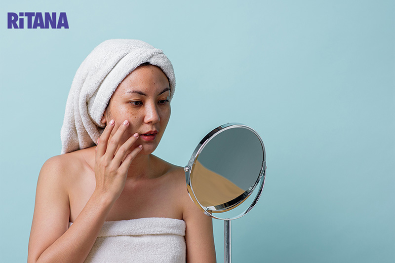 Nám da là một trong những vấn đề da liễu thường gặp ở phụ nữ