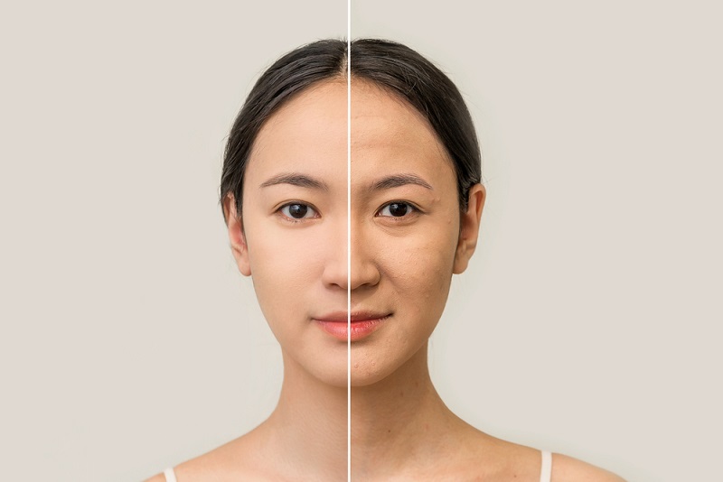 Nâng cơ mặt là gì và nâng cơ trẻ hóa da có hiệu quả không?