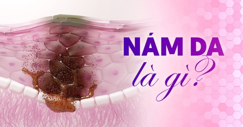 Nám da mặt là gì? 7 điều phái đẹp cần biết về nám da mặt