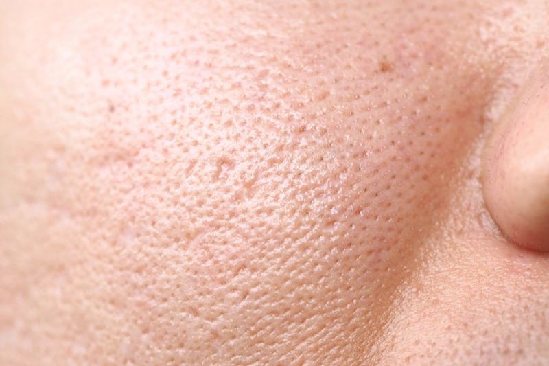 lỗ chân lông tắc nghẽn trên mặt
