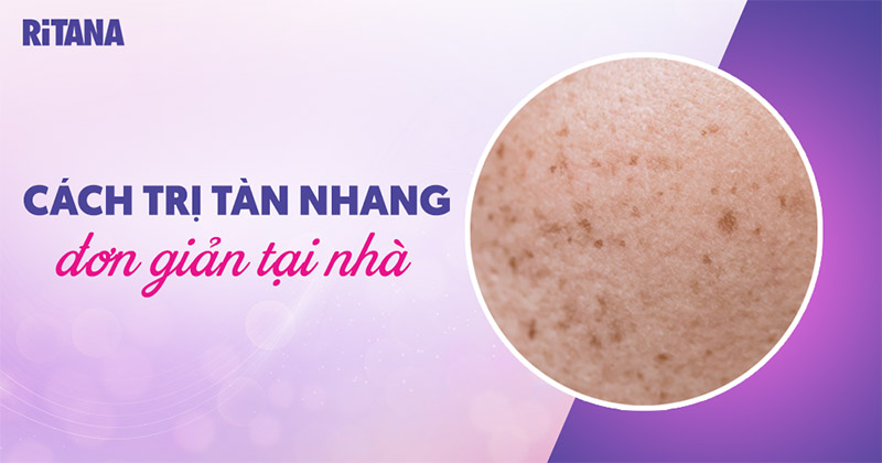 13 cách trị tàn nhang hiệu quả tại nhà, tận gốc nhanh và đơn giản