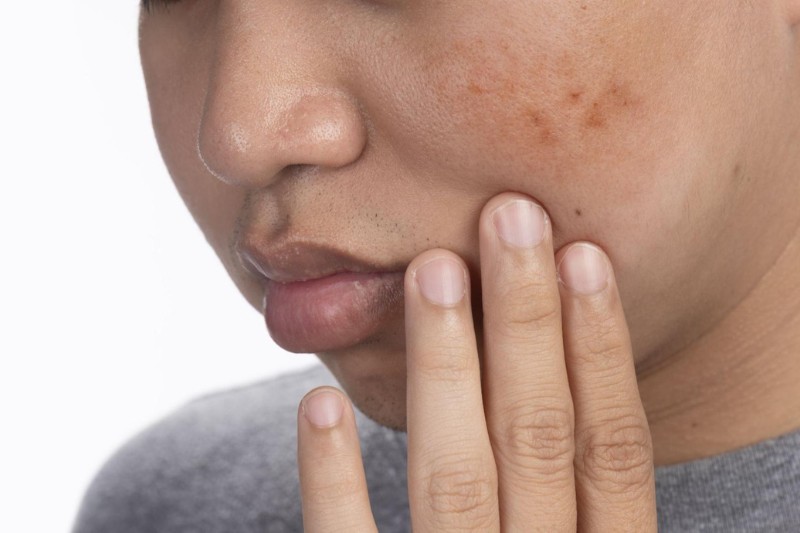 da bị sạm do sống thiếu khoa học