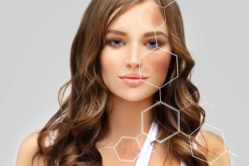 dạm sạm ở vùng mặt và cổ