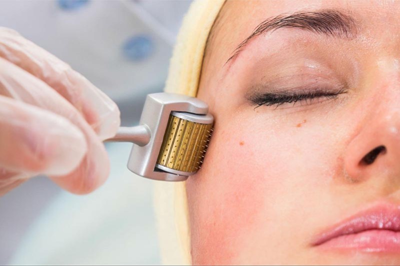 lăn kim trị nám da