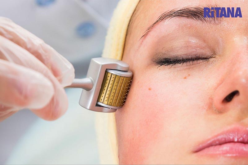 Lăm kim trị nám da hiệu quả