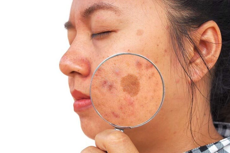 Nám chân sâu là gì? Nguyên nhân và bí quyết làm mờ nám hiệu quả