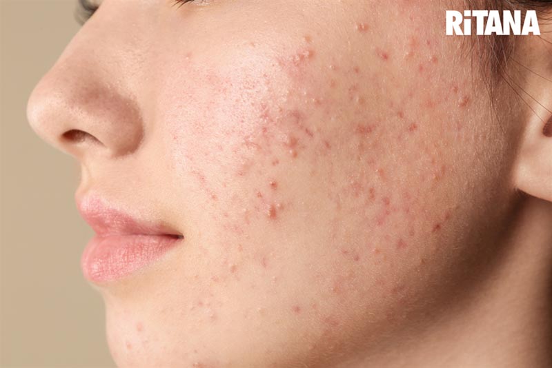 Thành phần của viên uống trị nám chân sâu
