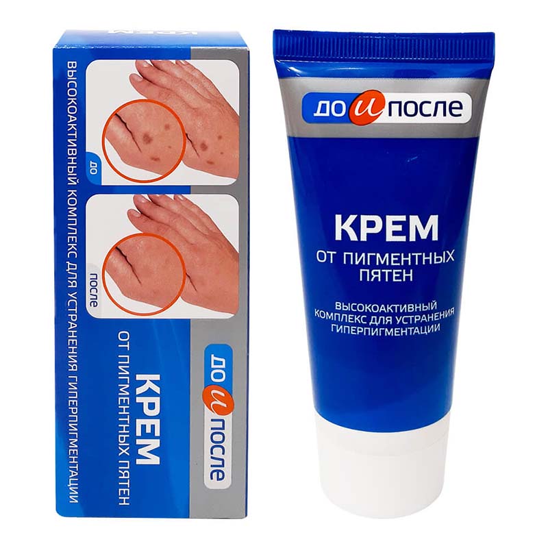 Kem Kpem trị đồi mồi cho da tay 