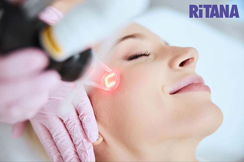 Bán laser kích thích sản sinh collagen