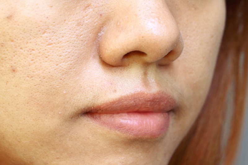 lỗ chân lông bị to