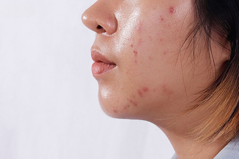 lỗ chân lông to do mụn trứng cá