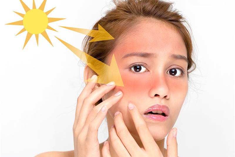 da dễ cháy nắng gây nám do ánh nắng