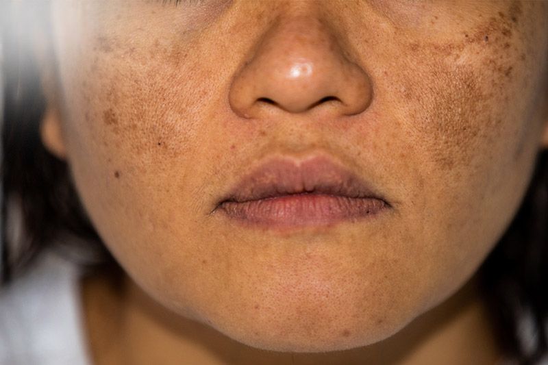 Các loại nám da phổ biến: Nguyên nhân, dấu hiệu và tác hại