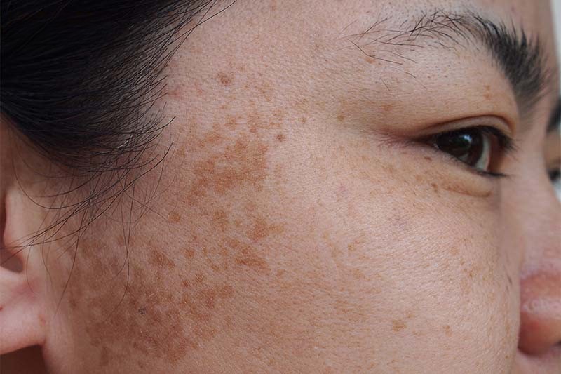 Nám mảng: Nguyên nhân, dấu hiệu và cách điều trị hiệu quả