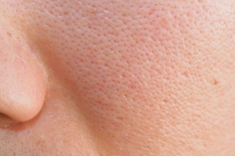 19 cách trị lỗ chân lông to ở mặt hiệu quả, dễ thực hiện ở nhà