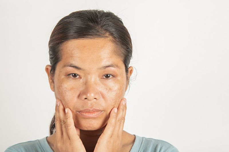19 cách trị nám da mặt lâu năm cả bên trong và ngoài ít ai biết