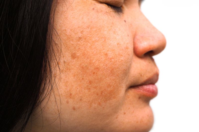9 cách trị nám nội tiết hiệu quả không nên bỏ qua