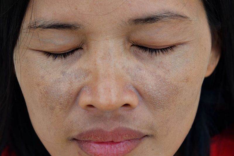 hình ảnh nám mảng