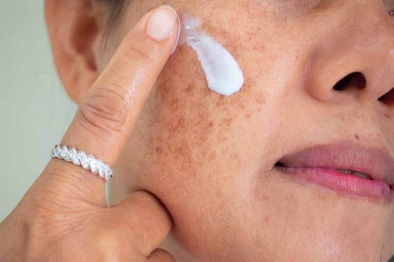 bôi kem trị nám mảng và nám chân sâu