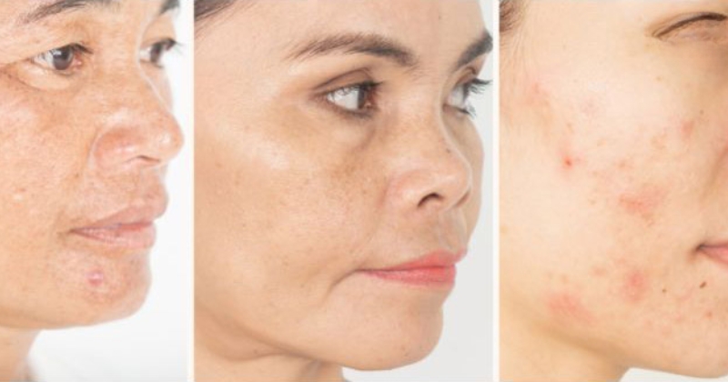 6 cách làm giảm sắc tố melanin nằm sâu bên trong da mặt hiệu quả