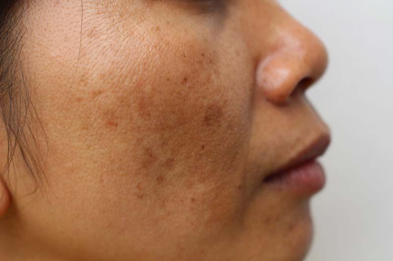 8 cách trị sạm da mặt tại nhà đơn giản lấy lại độ sáng mịn màng
