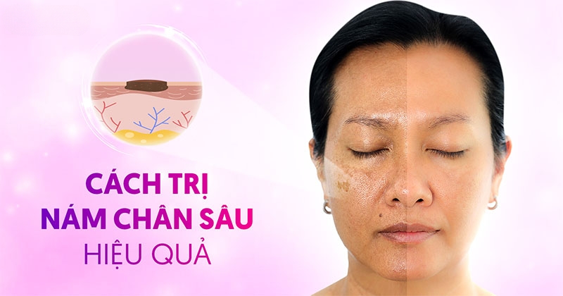 6 cách trị nám chân sâu tại nhà hiệu quả và phổ biến hàng đầu