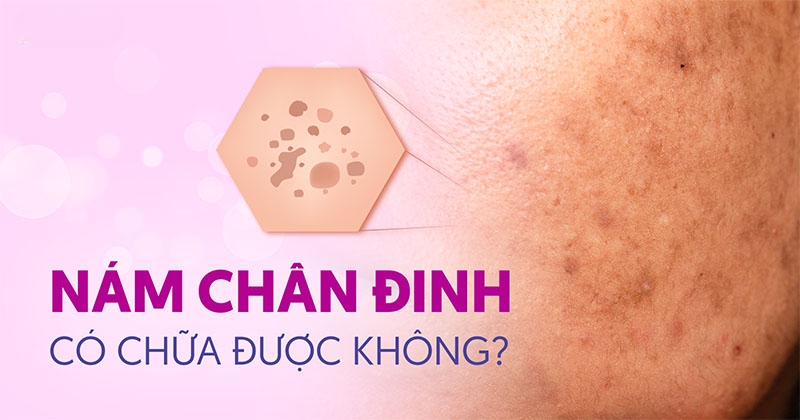 Nám chân đinh là gì? Dấu hiệu, nguyên nhân và cách phòng ngừa