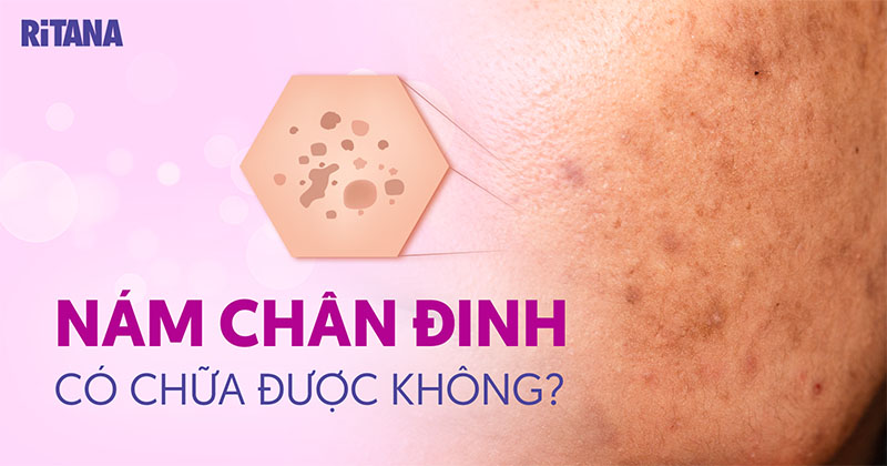 Nám chân đinh là gì? Dấu hiệu, nguyên nhân và cách phòng ngừa