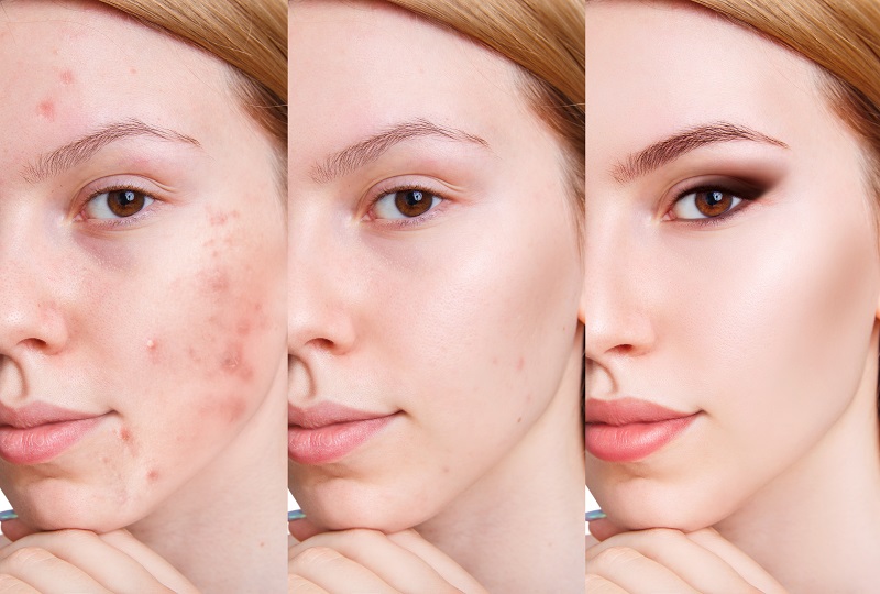 Các bước skincare sau khi nặn mụn có thể bạn chưa biết