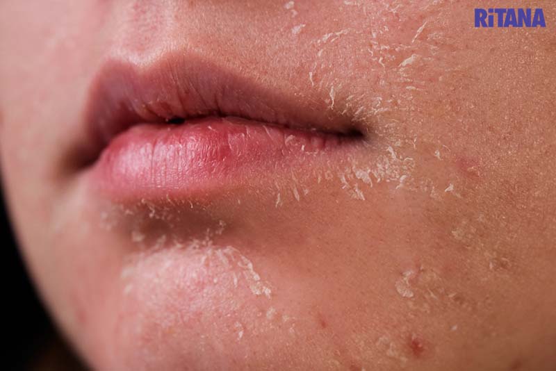 Cách chăm sóc da mùa đông tại nhà và 6 điều bạn nên hiểu rõ!