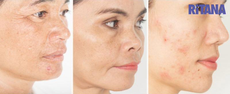 6 cách làm giảm sắc tố melanin nằm sâu bên trong da mặt hiệu quả