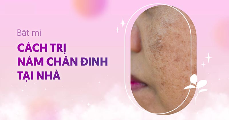 8 cách trị nám chân đinh tại nhà đơn giản, chị em nên tham khảo