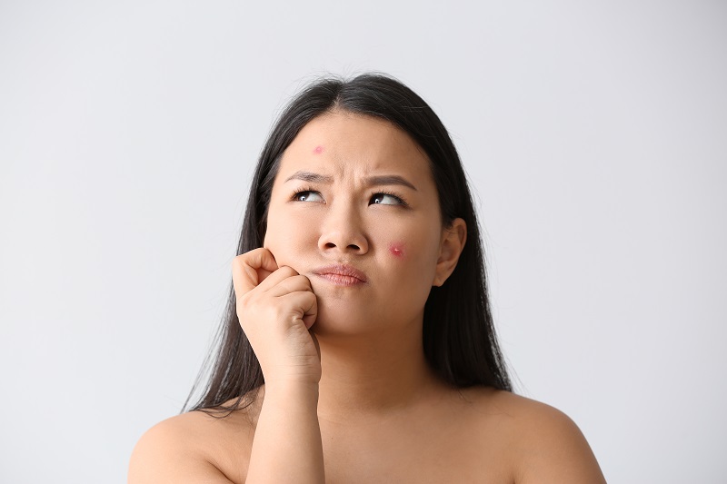 [Góc giải đáp] Da mụn có nên tẩy tế bào chết không?