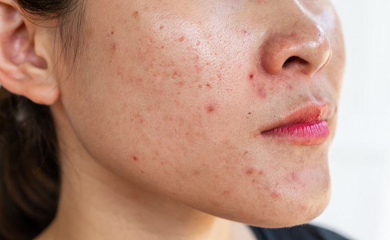 11 nguyên nhân bít tắc lỗ chân lông ở mặt phái đẹp cần biết