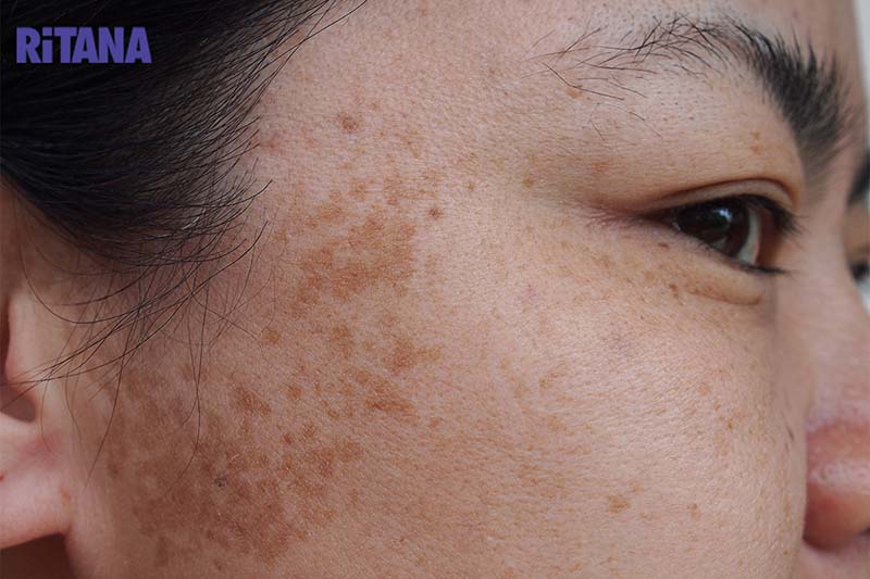 Da bị nám nhẹ do đâu? Phải làm sao để loại bỏ?