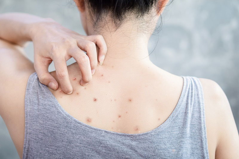 Nguyên nhân nổi mụn lưng và cách khắc phục hiệu quả