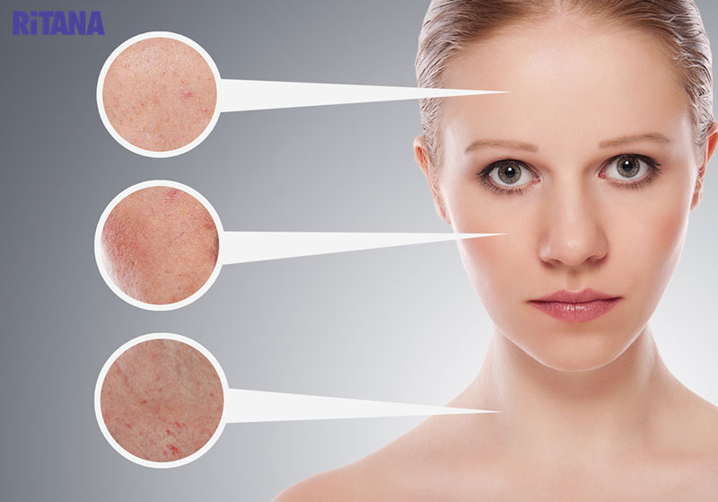 Phục hồi da sau mụn: Quy trình chăm sóc theo từng bước chi tiết