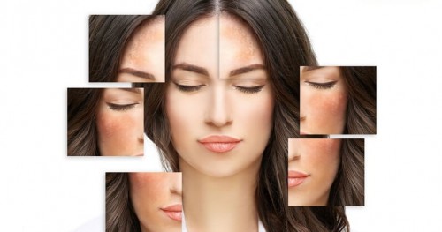 Nám sạm da mặt là gì? Nguyên nhân làm da bị sạm đen thường gặp