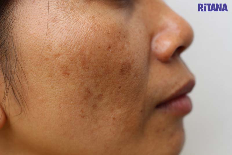 8 cách trị sạm da mặt tại nhà đơn giản lấy lại độ sáng mịn màng