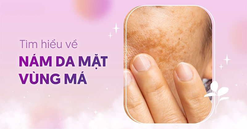 Nám da vùng má (gò má): Biểu hiện, nguyên nhân và cách chữa trị