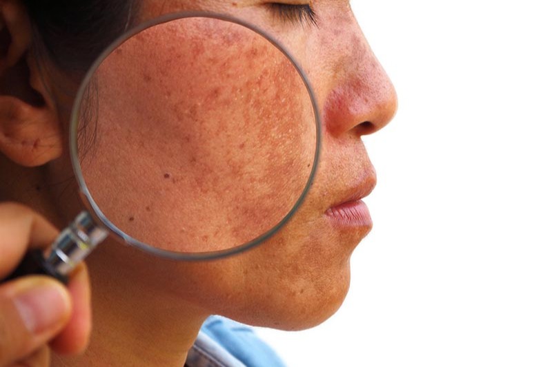 hình ảnh nám hỗn hợp trên da mặt