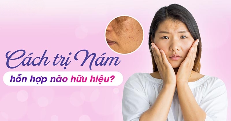 Nám hỗn hợp là gì? Hình ảnh nhận biết và cách điều trị