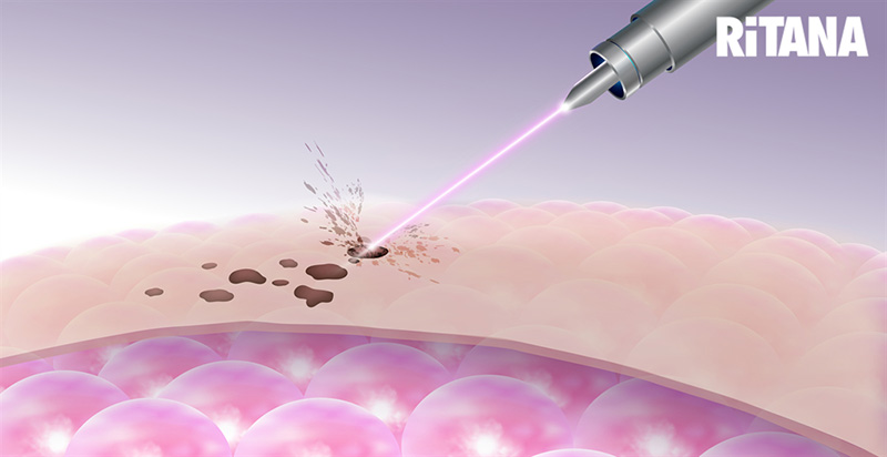 Cơ cấu hóa động trẻ hóa bằng công nghệ laser
