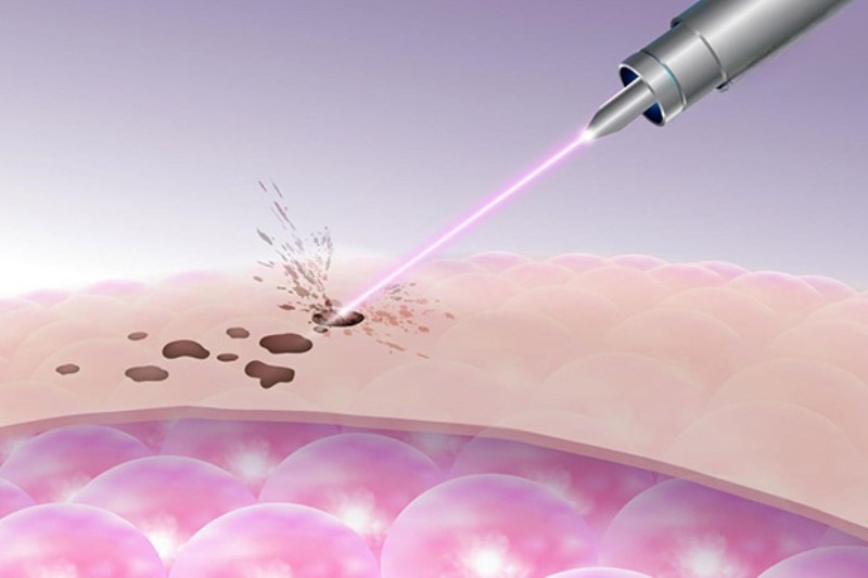 bắn laser chữa đồi mồi