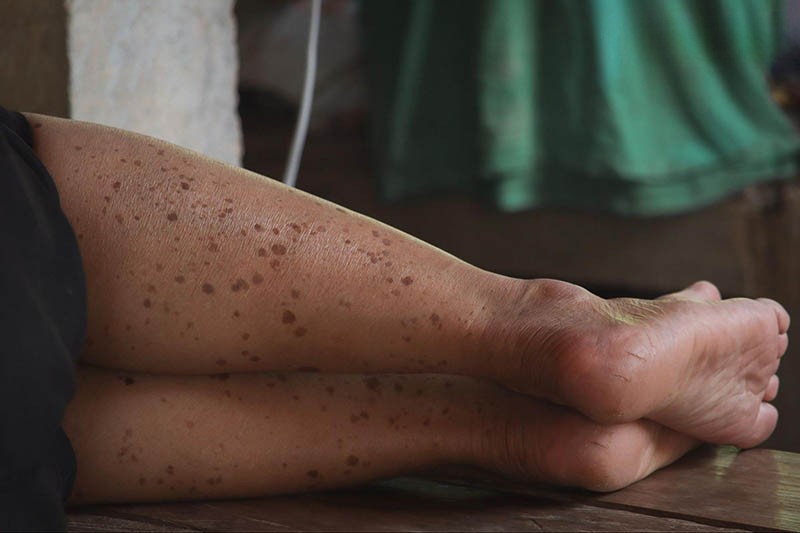 hình ảnh đồi mồi trên da chân