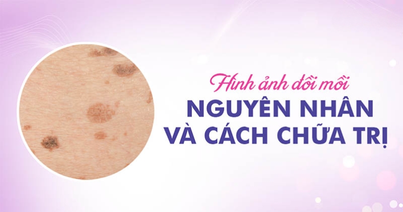 Chi tiết 5 hình ảnh đồi mồi trên da đủ mọi cấp độ và tình trạng