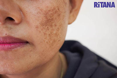 Hình ảnh nám chân sâu