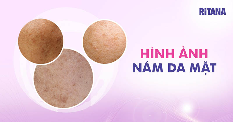 Hình ảnh nám da mặt chi tiết của các loại nám thường gặp