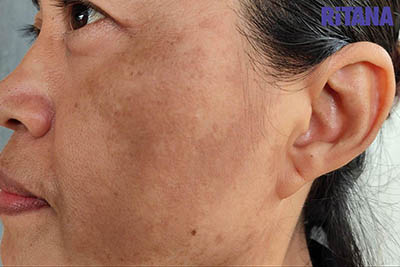 Hình ảnh nám mảng