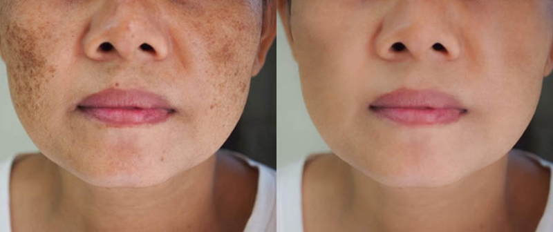 ảnh lăn kim trị nám